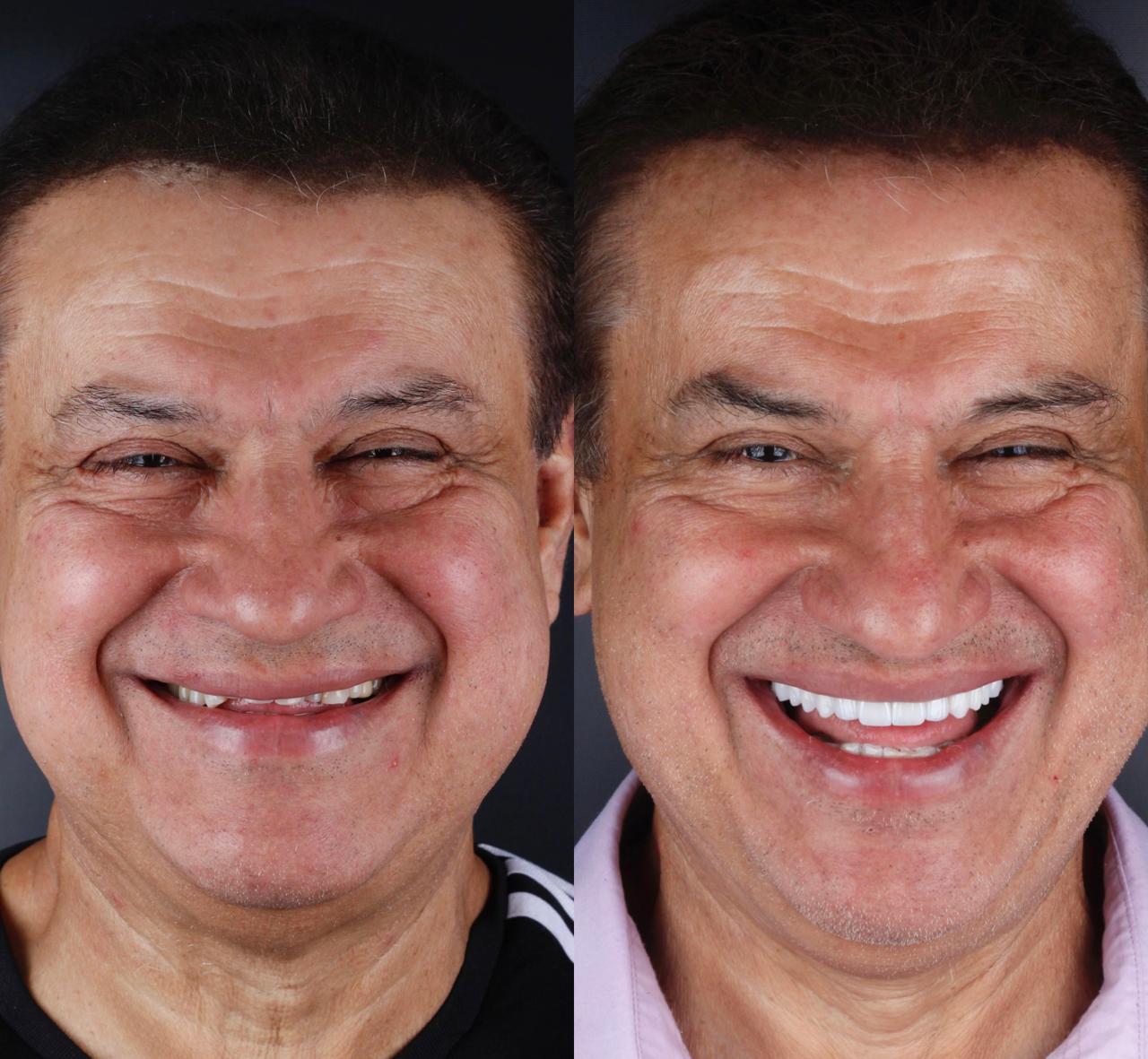 Antes e depois - Lente de Porcelana